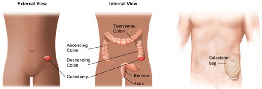 abt-colostomy-surgery