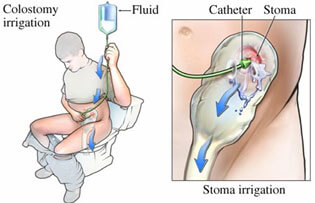 irrigation-img